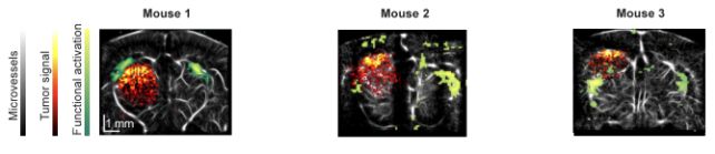 New Ultrasound Technique Lets Scientists Watch Deadly Cancer Make a Nest in The Brain