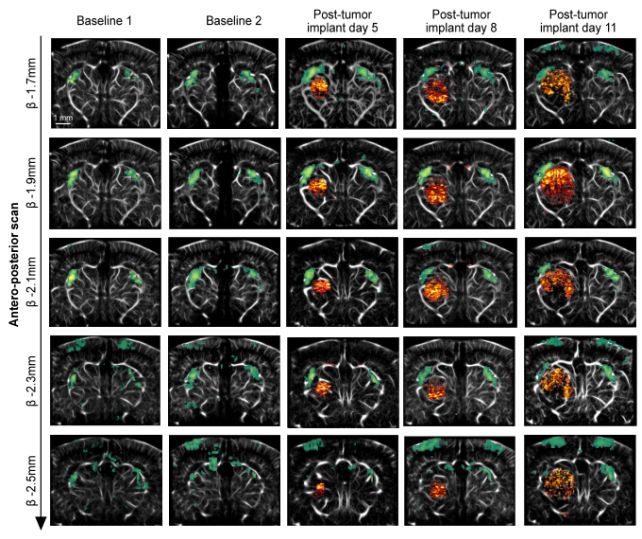 New Ultrasound Technique Lets Scientists Watch Deadly Cancer Make a Nest in The Brain