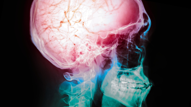 The Treatment Window For Some Strokes May Be Far Longer Than We Thought, But There's a Catch