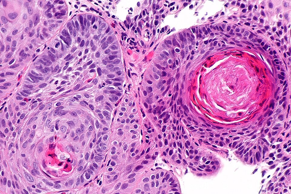 This Traditional Chinese Medicine Formula Kills Drug-Resistant Cancer Cells in The Lab