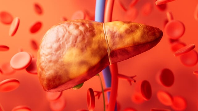 Fatty liver