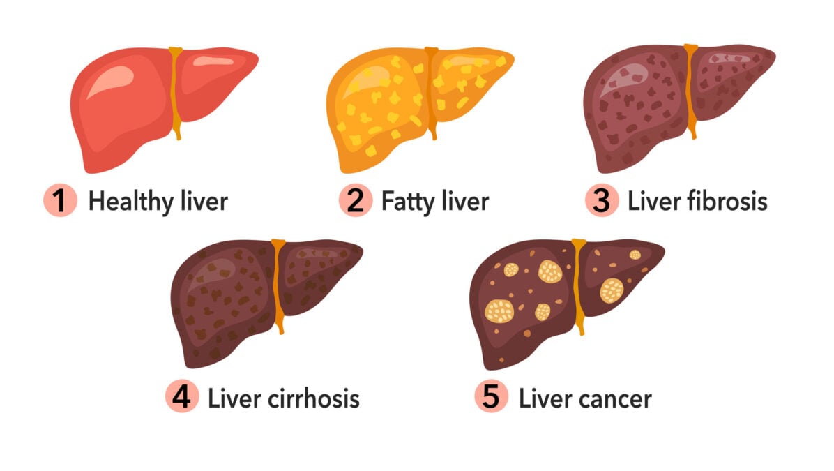 Stages of liver damage infographic concept vector illustration. Fatty liver, cirrhosis and liver cancer in flat design on white background.