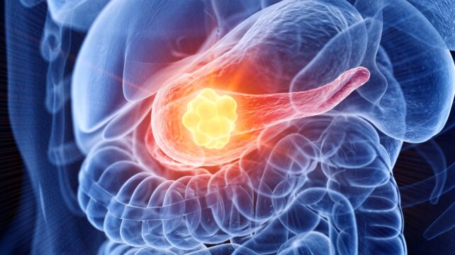 New Pancreatic Cancer Vaccine Sparked Immune Responses in 99% of Patients