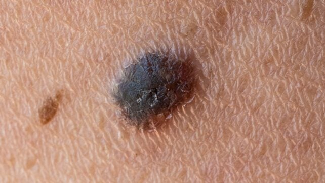 World-First Cancer Vaccine Cuts Melanoma Recurrence or Death Risk by 42% in Landmark Trial