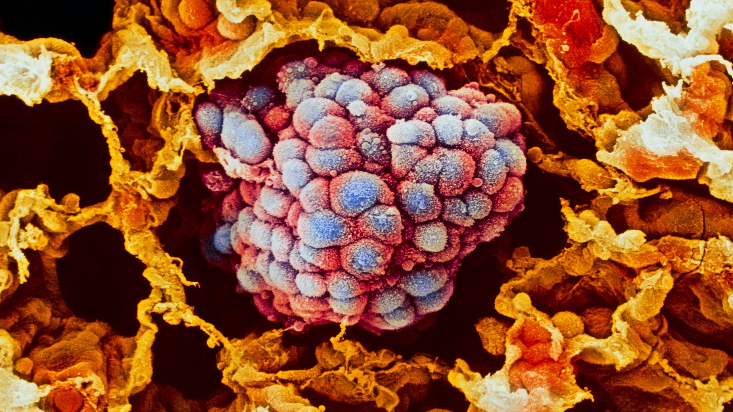 Un médicament anti-parasitaire pour traiter le cancer du poumon résistant aux médicaments