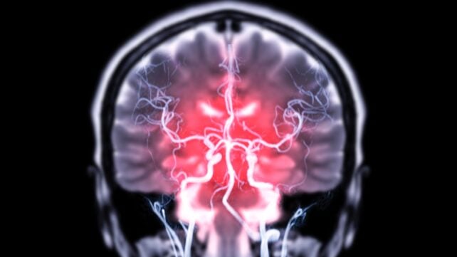 Obesity Linked to Twice The Volume of Brain Abnormalities, Study Finds