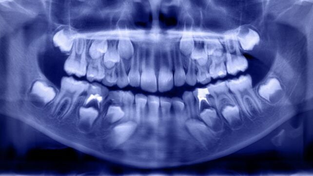 Higher Levels of 19 Potentially Toxic Chemicals Found in The Teeth of Children With Autism