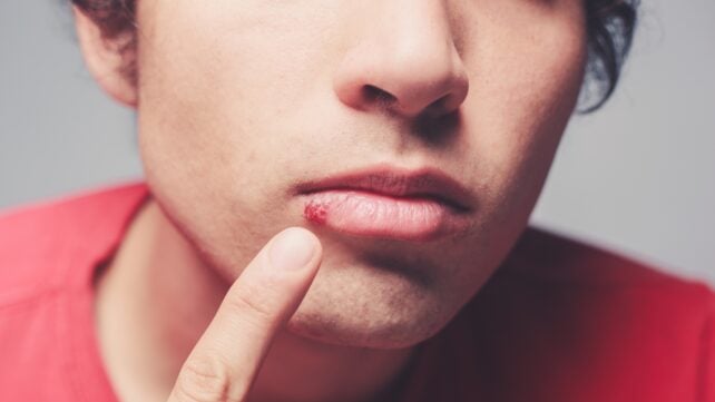 Herpes Virus Appears to Hijack The Brain's Immune Cells, And It Could Have Serious Consequences