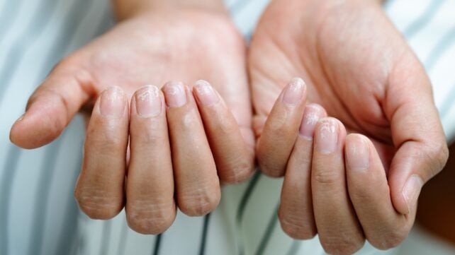 Some People Taking Ozempic-Like Drugs Are Reporting Their Fingernails Detaching