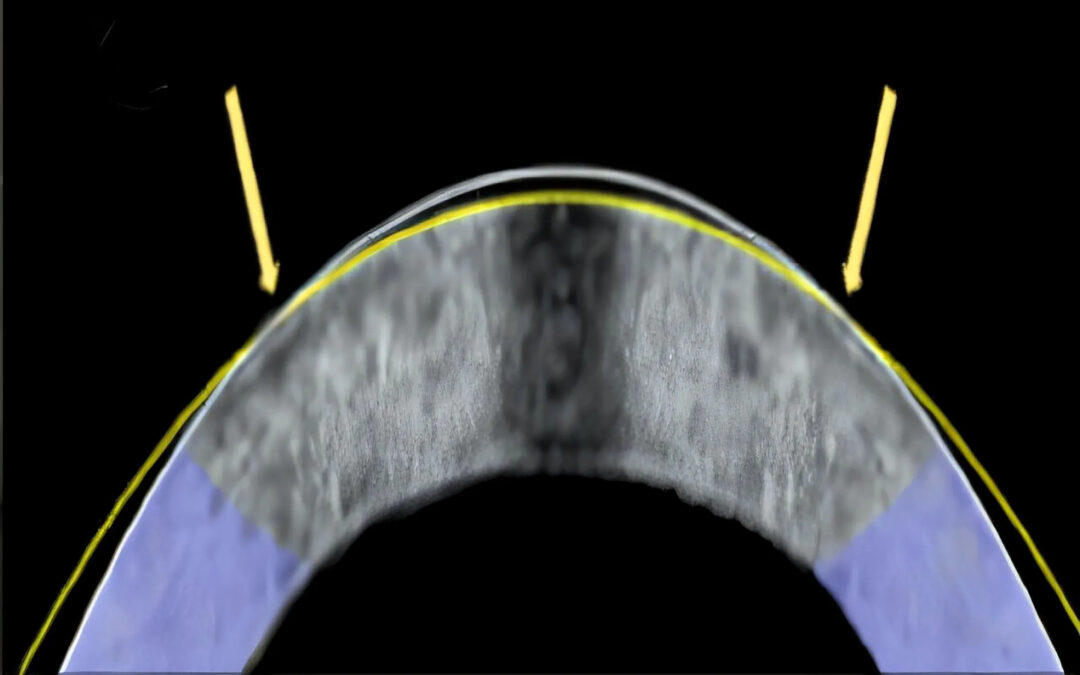 Cross section of a rabbit cornea with a white line marking its original curvature and a yellow line marking its flatter shape after electromechanical reshaping.