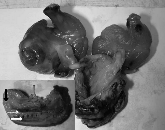 baby-teratoma