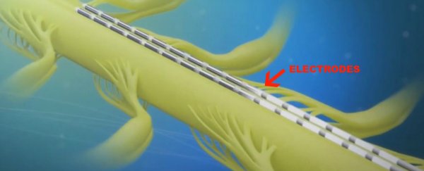 This device can bypass spinal injuries to help defeat paralysis