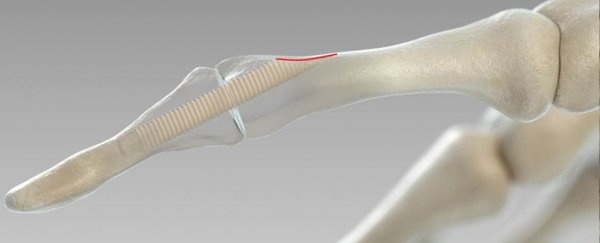There's a new method for fixing broken bones using pieces of other people's bones