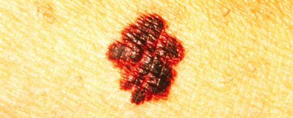 Should you worry about that mole? Here's how to tell