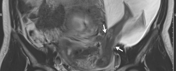 This baby's legs are poking through a tear in its mother's uterus wall