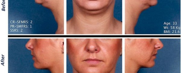 The FDA is eager to approve a drug that gets rid of your double chin