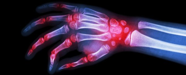 The mutation that helped ancient humans survive frostbite probably gave us arthritis
