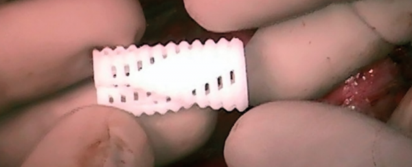 New 3D-printed implants save three babies from life-threatening illness