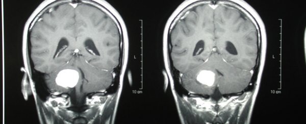 Scientists just made big progress in fighting this incurable form of brain cancer