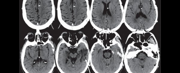 An anti-anxiety drug has "woken up" a minimally-conscious patient