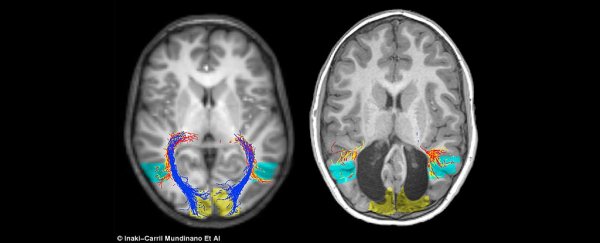 Boy Missing Visual Section of His Brain Can Somehow Still See