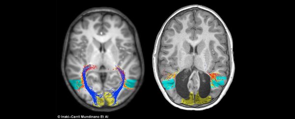 Boy missing visual section of his brain can somehow still see, stunning doctors