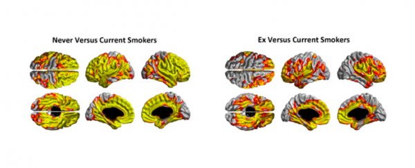 Smoking thins a vital part of your brain, but quitting reverses the damage