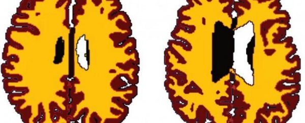 Brains of overweight people look 10 years older than those of lean people