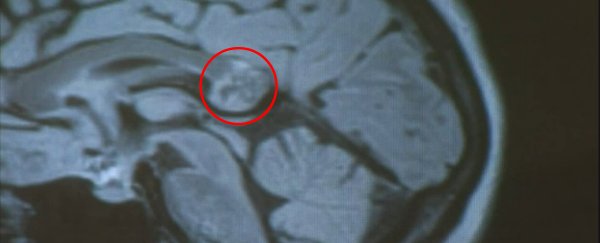 Woman’s brain tumour turns out to be her "embryonic twin", surgeons find