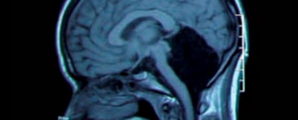This woman lived 24 years without knowing she was missing her entire cerebellum