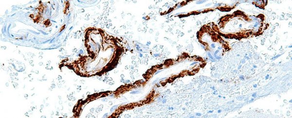 New compound may block the proteins causing Alzheimer’s disease, research suggests