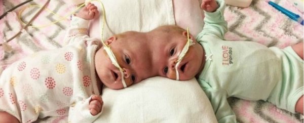 Conjoined twins have survived one of the world's rarest surgeries