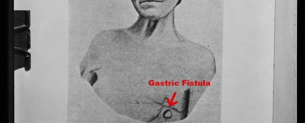This horrifying experiment led to our understanding of human digestion