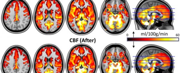 Magic Mushrooms Found to Be "Resetting" Brain Circuits in Depressed People