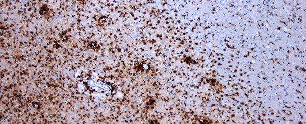 Stem cell treatment halts MS progression in 91% of patients