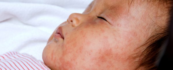 The US is in the middle of its biggest measles outbreak this year