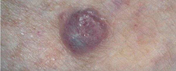 New drug helps patients with melanoma live "significantly" longer
