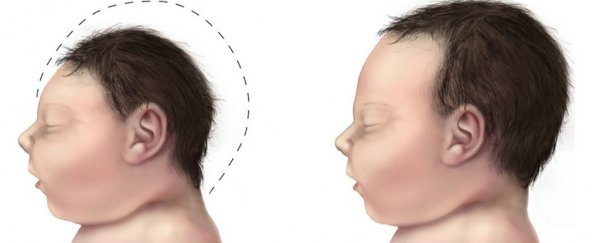 The first babies with Zika virus have been born in continental US