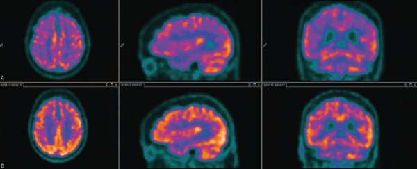 A break in delirium research might have just solved a 2,500-year-old medical mystery