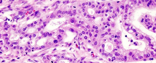 Scientists revert pancreatic cancer cells in mice back to normal, healthy cells