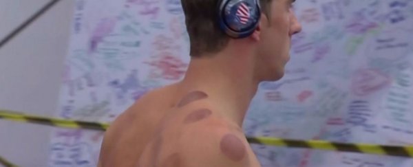 Here's how cupping therapy works, and why so many Olympians use it