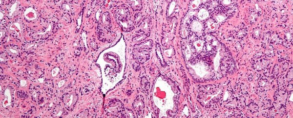 Scientists have identified the molecules most capable of fighting prostate cancer