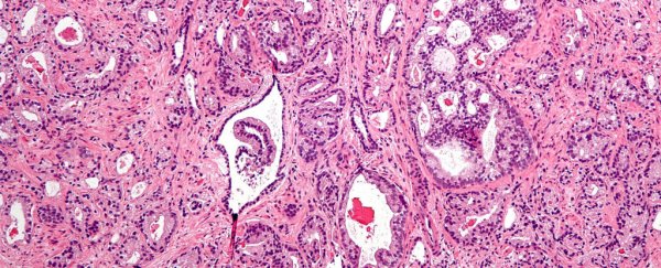 Doctors could soon cut out prostate cancer more accurately than ever before
