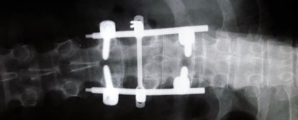 Researchers have developed a low-cost surgical device that'll help reduce chronic back pain