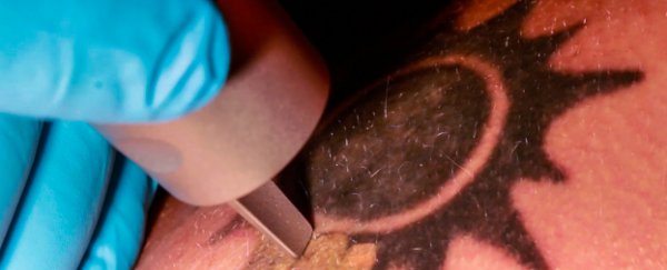 WATCH: The science behind laser tattoo removal