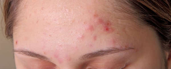 Good news: people with acne appear to be protected against the signs of ageing