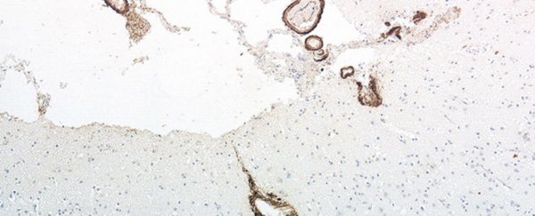 There's now even more evidence that Alzheimer's could be transmitted through medical procedures