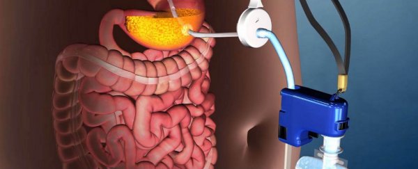The FDA just approved this gross weight-loss device that sucks food from your stomach