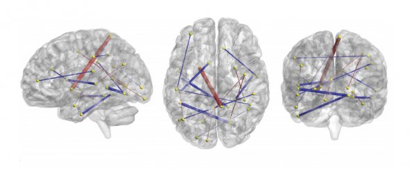 A single brain scan has been used to accurately predict autism at just 6 months old
