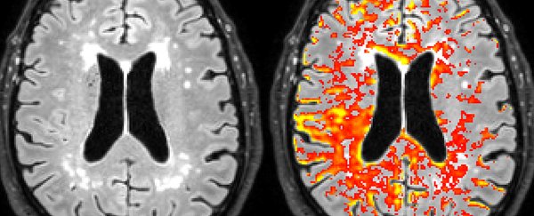 One gene is a major risk factor for Alzheimer's disease, and we may finally know why